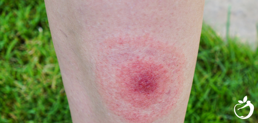 Blog Post Header Image - 8 Things You Need to Know About Lyme Disease. Image of classic bull's-eye rash.