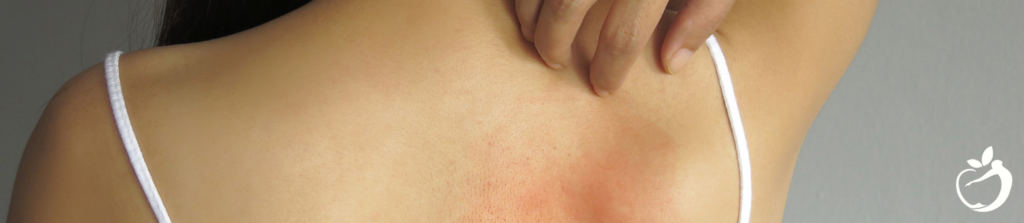 To show person scratching a rash associated with allergies.
