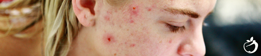 Image of a person suffering from sever acne demonstrating the association between gut health and skin.