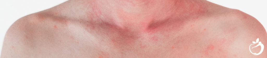 Image showing flushing on a persons neck and chest, a symptom of Mast Cell Activation Syndrome.