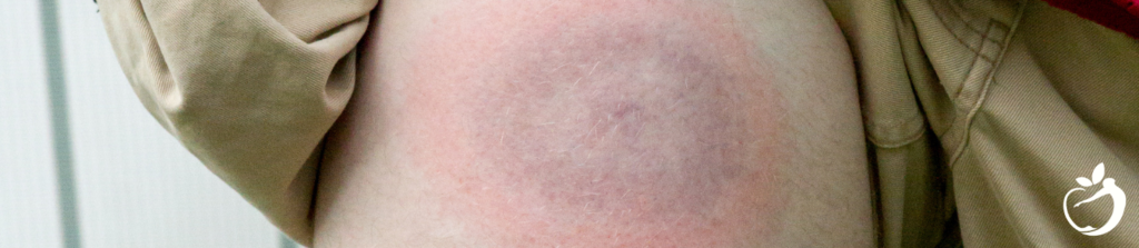 bullseye lyme disease rash on a leg