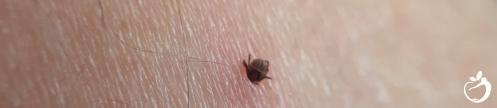 a tick burrowed into someones skin